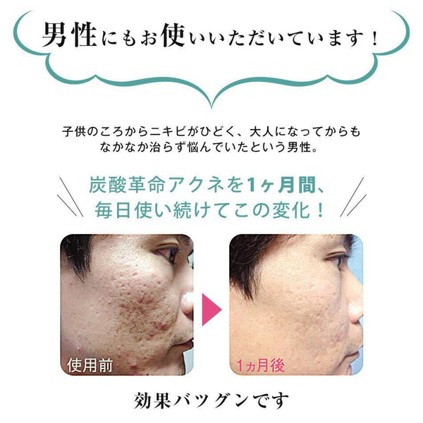 P-4-SYN-TAN-AC-1-Tansan Kakumei Acne Carbonic Acid Face Treatment 1 Set.jpg